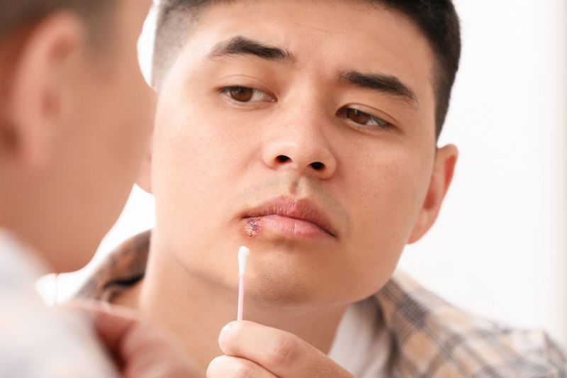 the-cold-truth-about-cold-sores