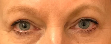 Eyelid-After-Facing-Patient-1