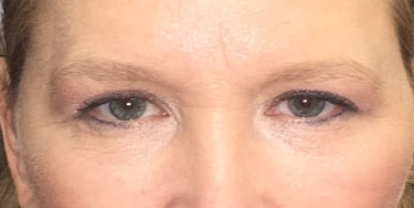 Eyelid-After-Facing-Patient-2