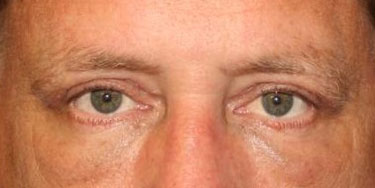 Eyelid-After-Facing-Patient-3
