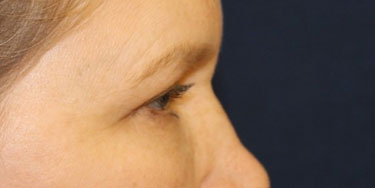 Eyelid-After-Profile-Patient-2