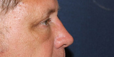 Eyelid-After-Profile-Patient-3