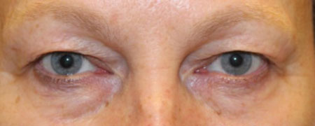 Eyelid-Before-Facing-Patient-1
