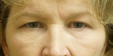 Eyelid-Before-Facing-Patient-2