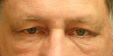 Eyelid-Before-Facing-Patient-3-compressed