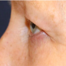 Eyelid-Before-Profile-Patient-1