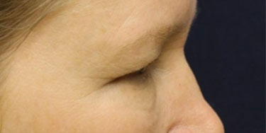 Eyelid-Before-Profile-Patient-2