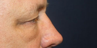 Eyelid-Before-Profile-Patient-3