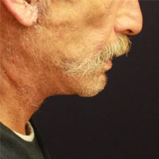 Neck-Lift-After-Profile-Patient-2