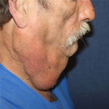 Neck-Lift-Before-Profile-Patient-2