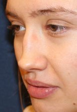 Septorhinoplasty-Before-Angle-Patient-3